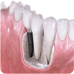 Dental Implants