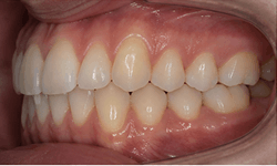 Patient uploading photos of teeth for dental review