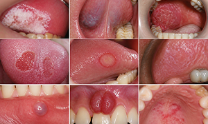 Oral Pathology