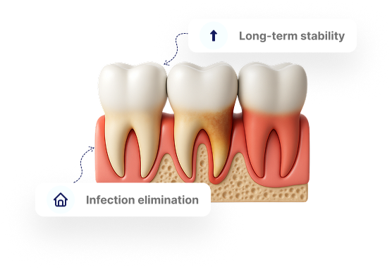 Moderate Periodontitis