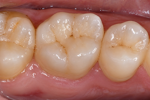 Example of taking a focused close dental photo