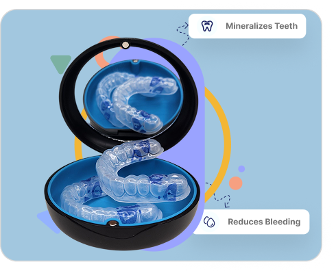 Custom Remineralization Tray