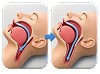 Airway opens illustration